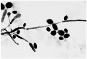 <strong> The presence of the specimen shown in the figure in a vaginal discharge is evidence of infection with</strong> A) Candida albicans. B) Neisseria gonorrhoeae. C) Treponema palladium. D) Chlamydia trachomatis. E) Trichomonas vaginalis.