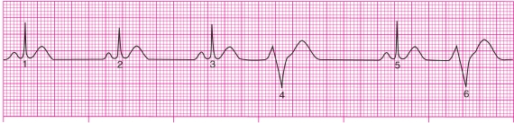 <strong>When auscultating heart sounds of a patient, the clinician reports normal beats followed by few abnormal beats.An ECG reveals the following tracing.What is this consistent with? </strong> A) Premature ventricular contractions B) Escape rhythm C) Ventricular fibrillation D) Second-degree AV block.