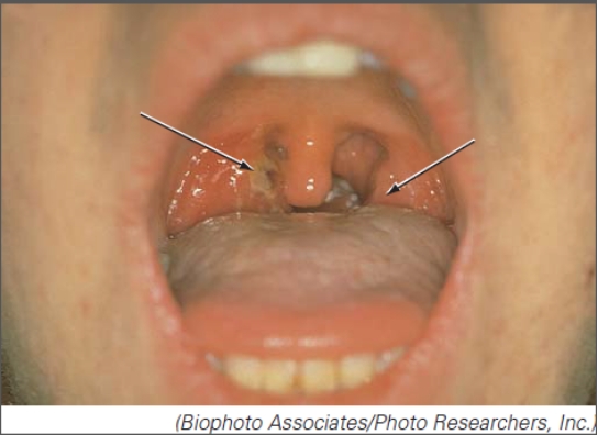 <strong>Select the organism responsible for this respiratory tract disorder. </strong> A)Streptococcus B)Haemophilus C)Bordetella D)Neisseria