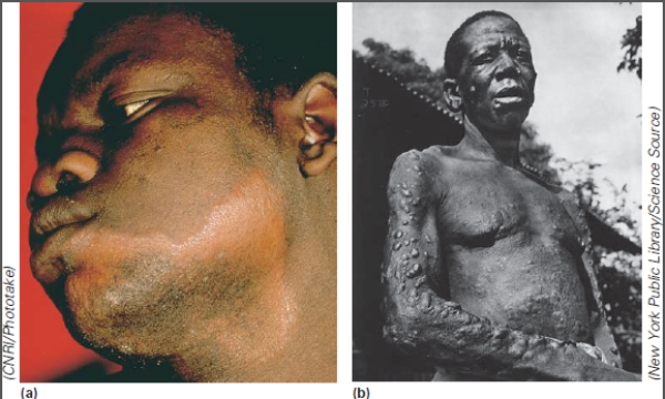 <strong>These individuals have: </strong> A)rabies B)West Nile Fever C)tetanus D)polio E)Hansen's disease