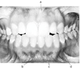 <strong>In the following illustration, structure d is the </strong> A) Mandibular labial frenum B) Mucogingival junction C) Mucobuccal fold D) Maxillary labial frenum