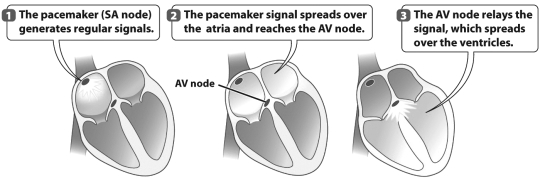 <strong>The figure below shows how a pacemaker aids in the regulation of a human heart. As a result of step 3 in this figure,</strong> A) the atria are in systole. B) the right side of the heart is in diastole. C) both the atria and the ventricles are in systole. D) the ventricles are in systole.