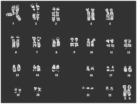 <strong>This is the karyotype of an individual with a genetic disorder. What is the cause of this disorder?</strong> A) The individual has more than one X chromosome. B) The individual has three copies of one of their chromosomes. C) The individual has fewer than the normal number of autosomes. D) Some of the chromosomes of this individual are bent rather than straight.