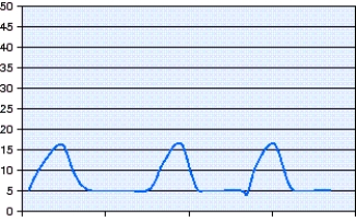 <strong>Which mode of ventilation is shown in the pressure-time scalar in the figure? </strong> A) Pressure-Controlled Continuous Mandatory Ventilation (PC-CMV) B) Volume-Controlled Continuous Mandatory Ventilation (VC-CMV) C) Pressure-Controlled Synchronized Intermittent Mandatory Ventilation (PC-SIMV) D) Volume-Controlled Synchronized Intermittent Mandatory Ventilation (VC-SIMV)