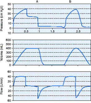 <strong>Calculate the static compliance using the information from the scalar below. </strong> A) 10 mL/cm H<sub>2</sub>O B) 16 mL/cm H<sub>2</sub>O C) 20 mL/cm H<sub>2</sub>O D) 80 mL/cm H<sub>2</sub>O
