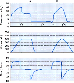 <strong>Calculate the airway resistance (R<sub>aw</sub>)using the information from the scalar below. </strong> A) 0.9 cm H<sub>2</sub>O/L/sec B) 1.1 cm H<sub>2</sub>O/L/sec C) 22.4 cm H<sub>2</sub>O/L/sec D) 60 cm H<sub>2</sub>O/L/sec