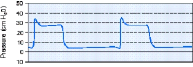 <strong>During pressure-controlled continuous mandatory ventilation (PC-CMV)the respiratory therapist observes the pressure-time scalar shown below.The most appropriate action to take is which of the following? </strong> A) Adjust the inspiratory time. B) Increase the flow rate setting. C) Adjust the inspiratory rise time control. D) Increase the peak inspiratory pressure setting.