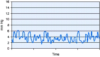 <strong>During the introduction of a pulmonary artery catheter the waveform seen in the figure is visible on the monitor.This waveform represents which of the following locations? </strong> A) Right atrium B) Right ventricle C) Pulmonary artery D) Pulmonary capillary