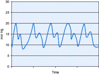 <strong>The waveform of a pulmonary catheter,shown in the figure,is located in which of the following? </strong> A) Right atrium B) Pulmonary artery C) Right ventricle D) Pulmonary capillary with a wedge