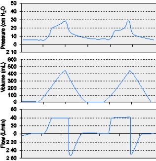 <strong>The graphics below indicate which of the following conditions? </strong> A) Auto PEEP B) Active exhalation C) Inadequate flow setting D) Increased expiratory resistance