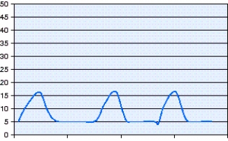 <strong>Which mode of ventilation is shown in the pressure-time scalar in the figure? </strong> A) Pressure-controlled continuous mandatory ventilation (PC-CMV) B) Volume-controlled continuous mandatory ventilation (VC-CMV) C) Pressure-controlled intermittent mandatory ventilation (PC-IMV) D) Volume-controlled intermittent mandatory ventilation (VC-IMV)