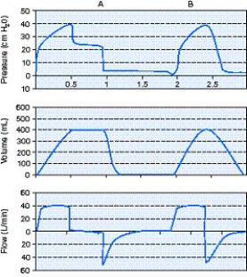 <strong>What is the trigger variable for the A breath shown in the figure below? </strong> A) Flow B) Time C) Pressure D) Volume