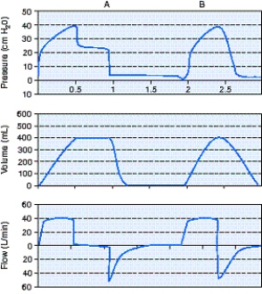 <strong>Calculate the static compliance using the information from the scalar below. </strong> A) 10 mL/cm H₂O B) 16 mL/cm H₂O C) 20 mL/cm H₂O D) 80 mL/cm H₂O