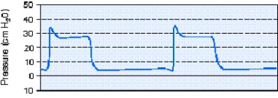 <strong>During pressure-controlled continuous mandatory ventilation (PC-CMV)the respiratory therapist observes the pressure-time scalar shown below.The most appropriate action to take is which of the following? </strong> A) Adjust the inspiratory time. B) Increase the flow rate setting. C) Adjust the inspiratory rise time control. D) Increase the peak inspiratory pressure setting.