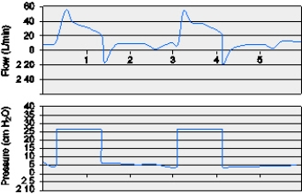 <strong>A patient with asthma is being ventilated in PSV,5 cm H₂O,with CPAP of 5 cm H₂O.The patient has chest wall retractions on most breaths and appears to have an increased WOB.The following graphic occurred the entire time the respiratory therapist was assessing the patient.What does this graphic demonstrate? </strong> A) Trigger asynchrony B) Mode asynchrony C) PEEP asynchrony D) Cycle asynchrony