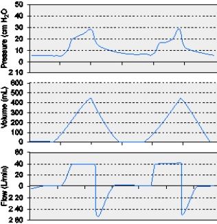 <strong>The graphics below indicate which of the following conditions? </strong> A) Auto-PEEP B) Active exhalation C) Inadequate flow setting D) Increased expiratory resistance
