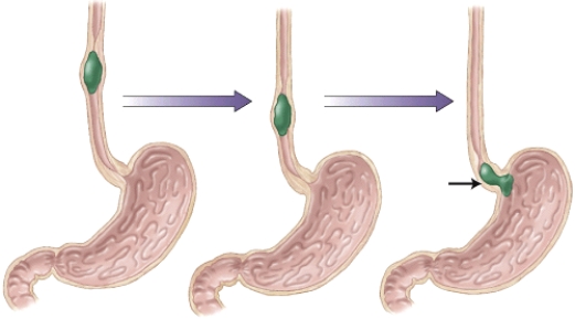 <strong>What might occur if the sphincter denoted here doesn't close correctly, and some of the contents from the stomach enter into the esophagus?  </strong> A) Choking B) Constipation C) Heartburn D) Peptic ulcers <div style=padding-top: 35px> 