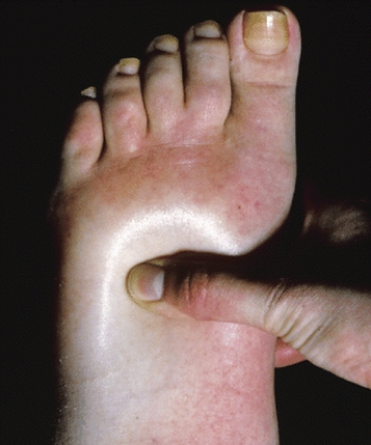 <strong>What is the condition called that is depicted in this photograph? SPL/Photo Researchers, Inc.</strong> A) marasmus B) edema C) osmosis D) myosin