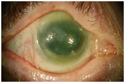 Vitamin A deficiency can result in permanent blindness, as illustrated in this picture. Discuss blindness from vitamin A deficiency occurs in the context of vitamin A's role in tissue formation. Use the following terms in your answer: epithelial tissue, mucus, differentiation, keratin, and a definition of xerophthalmia.