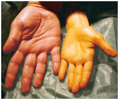 <strong>This visual represents a toxicity of ______ leading the toxicity disease _______. </strong> A) beta-carotene, hypercarotenemia B) niacin, pellagra C) vitamin A, xerophthalmia D) vitamin D, rickets