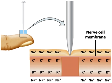 As illustrated in this picture, you feel a pinprick because it stimulates nerves under the skin. Describe the roles that sodium and potassium play in nerve impulse transmission. In your response, make sure to address the following: How are electrolyte concentrations of sodium and potassium disrupted? How does the nerve impulse travel through the nerve to signal the brain? How are electrolyte concentrations restored?  <div style=padding-top: 35px> 