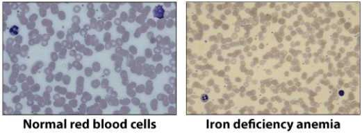 The pictures that you see here are of normal red blood cells and red blood cells when someone has iron deficiency anemia. Describe the differences between the cells. Why does too little iron cause the red blood cells to change?  <div style=padding-top: 35px> 
