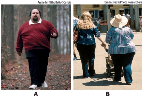 <strong>Based on their distribution of body fat, which of the persons is at increased risk for type 2 diabetes? </strong> A) Picture A B) Picture B