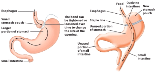 This diagram shows you the surgical procedure of gastric bypass. Explain what happens in the surgery. Why is food intake reduced as a result of this surgery? How is nutrient absorption affected?