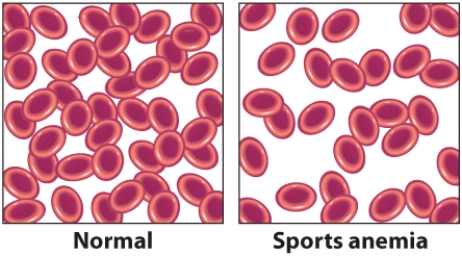Sheila is running for her first season on her high school cross country team. The visuals that you see here show you what normal red blood cells look like, and what Sheila's red blood cells look like, as she has sports anemia. What has caused her to develop sports anemia. Explain the changes from normal that occur in blood volume, the synthesis of red blood cells, percentage of blood that is red blood cells, and the total number of red blood cells with sports anemia. Is the transport of oxygen impaired with sports anemia? Does Sheila need to take an iron supplement to make the sports anemia go away?