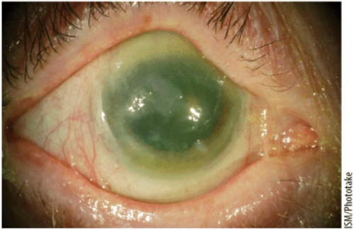 <strong>Xerophthalmia, as shown in this visual, is a leading cause of preventable blindness due to a deficiency of </strong> A) calcium. B) iodine. C) iron. D) vitamin A.