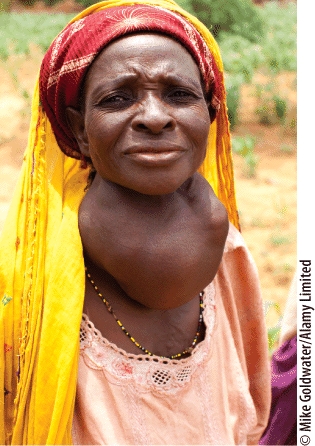 <strong>Goiter, as seen here, is a caused by an _____ deficiency. </strong> A) calcium B) iodine C) iron D) vitamin A