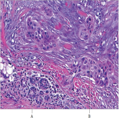 <strong>Figure 10.1 What is represented by the part of the figure labeled as B?</strong> A) normal tissue B) cancerous tissue C) adipose tissue D) lymph nodes E) red blood cells