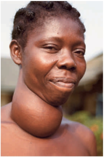 Figure 34.10 -The woman in the above photograph has been afflicted by ____.