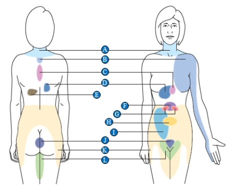 Figure 33.6 -The accompanying figure shows areas of referred pain that indicate an internal organ is damaged.Which letter corresponds to heart damage?