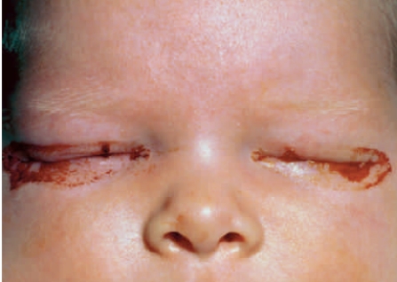 <strong>Figure 41.13A The disease acquired from the mother during childbirth shown in the above infant photograph is caused by ____. </strong> A) syphilis B) gonorrhea C) chlamydia D) HPV E) AIDS