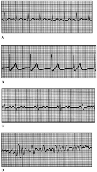 <strong> Figure 18.3 Using Figure 18.3, match the following:</strong> A) B B) C C) D D) A Normal sinus rhythm.