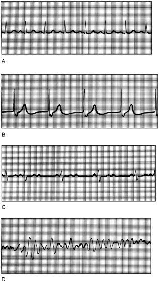 Figure 18.3Using Figure 18.3, match the following: -Second- degree heart block.