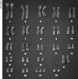 <strong> The karyotype above shows ________.</strong> A) abnormal sex chromosomes B) trisomy 21, a cause of Klinefelter syndrome C) Turner syndrome D) trisomy 21, a cause of Down syndrome