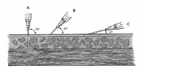 Using the illustration below,select the proper angle for the nurse to use in administering a subcutaneous injection for the average adult.