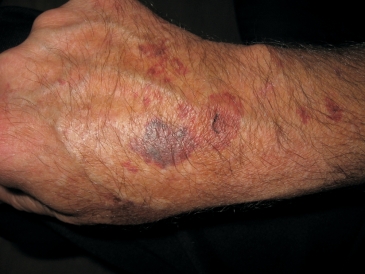 <strong> Red cell morphology such as the one at the tip of the pointer are associated with:</strong> A) von Willebrand's disease B) Glanzmann's thrombasthenia C) Thrombotic thrombocytopenic purpura D) All of the above
