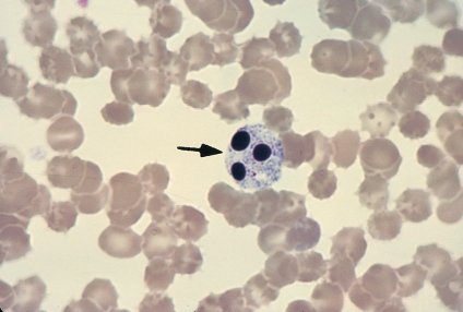 <strong> The cell at the tip of the pointer is:</strong> A) A basophil B) A malignant cell C) A degenerating neutrophil D) Not a cell; it's an artifact
