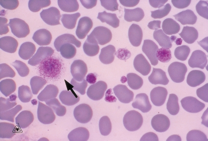 <strong> The cell at the tip of the pointer is a:</strong> A) Hairy cell B) Basket cell C) Degenerating lymphocyte D) Giant platelet