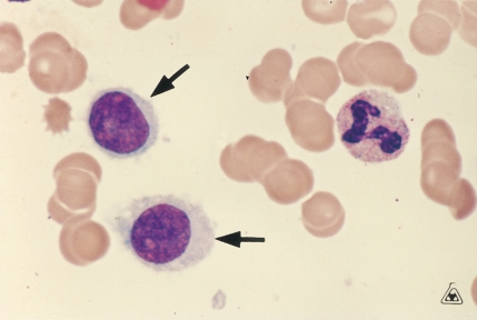 <strong> The cells at the tip of the pointer are most frequently associated with:</strong> A) CLL B) Hairy cell leukemia C) Sézary syndrome D) Multiple myeloma