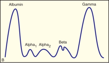 <strong> The protein electrophoresis pattern pictured above is most frequently associated with:</strong> A) Hodgkin's lymphoma B) Multiple myeloma C) Thalassemia major D) Essential thrombocytopenia