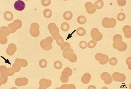 <strong> The phenomenon pictured above is known as rouleaux and is frequently associated with:</strong> A) An increased red cell count B) A decreased MCV and MCHC C) An elevated ESR D) All of the above