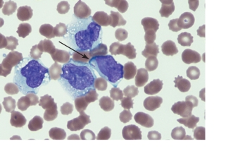 <strong> The cells pictured above are most consistent for:</strong> A) Acute myeloid leukemia B) Acute myelomonocytic leukemia C) Acute lymphoblastic leukemia D) Acute erythroid leukemia