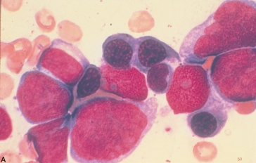 <strong> The cells pictured above are most consistent with:</strong> A) Acute myeloid leukemia B) Acute myelomonocytic leukemia C) Acute lymphoblastic leukemia D) Acute erythroid leukemia