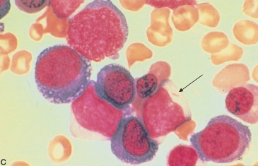 <strong> The structure at the end of the pointer is a(n):</strong> A) Auer rod B) Dohle body C) Engulfed bacteria D) None of the above