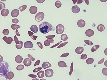 <strong> The cell at the tip of the pointer would be described as a/an:</strong> A) Acanthocyte B) Elliptocyte C) Sickle cell D) Stomatocyte
