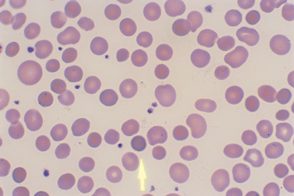 <strong> The cell at the tip of the pointer is referred to as a:</strong> A) Stomatocyte B) Target cell C) Normal erythrocyte D) Spherocyte